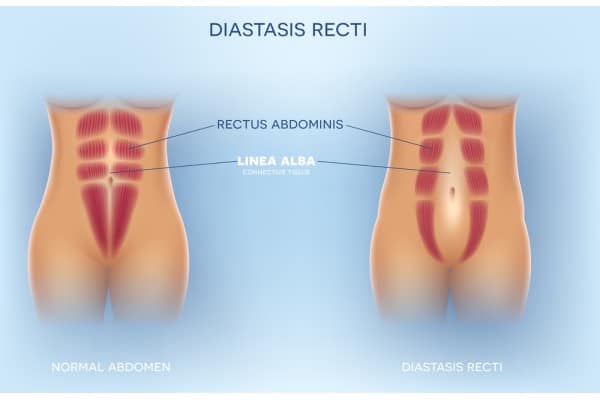 What Non-Surgical Options Are Available for Diastasis Recti Arnold?