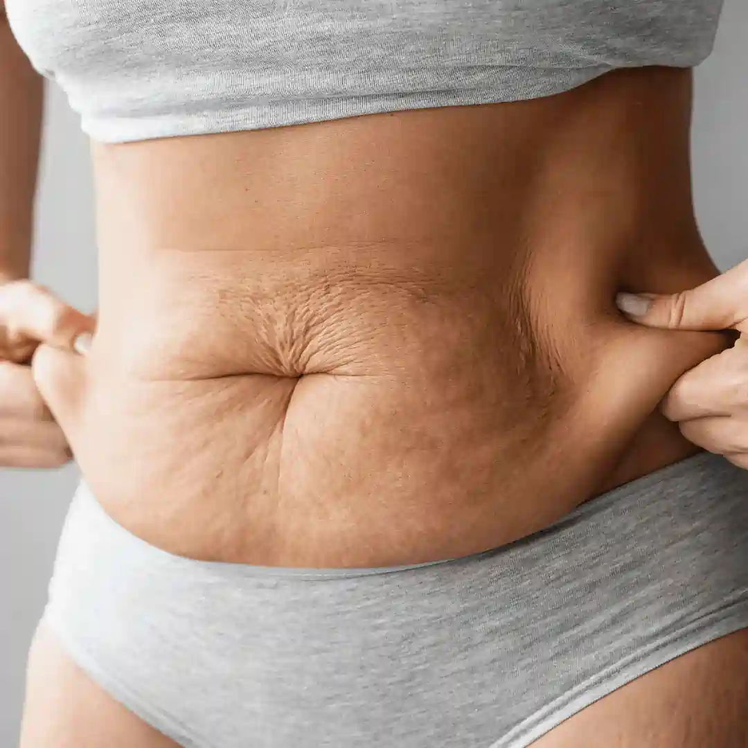 Is It Normal to Have Loose Skin After Pregnancy Arnold?